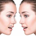 Rhinoplasty in Dubai