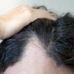 Stem Cell Therapy for Hair in Dubai