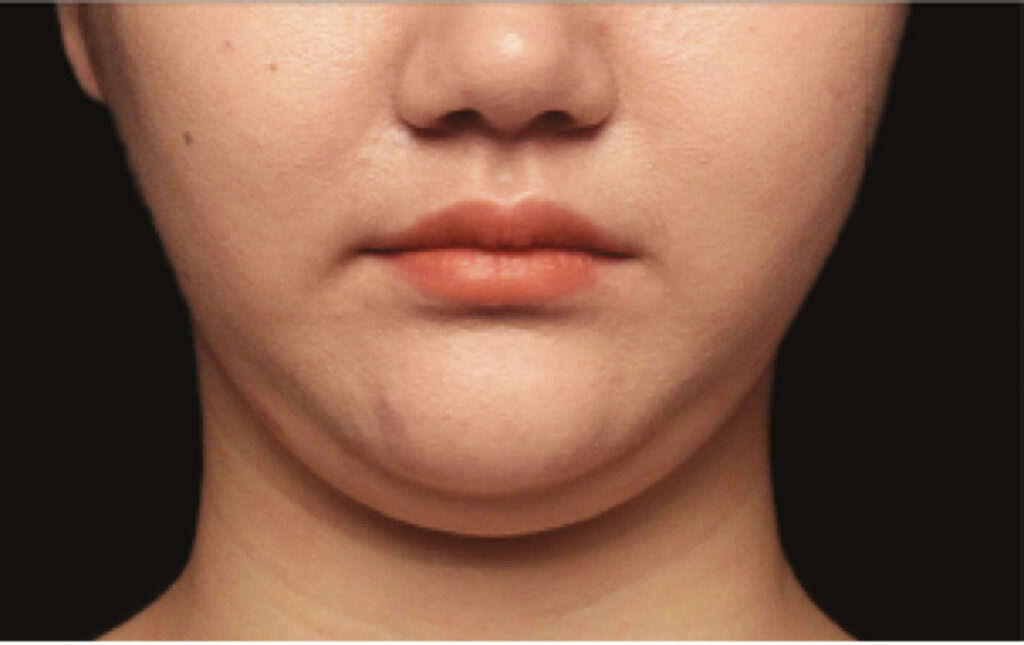 double chin liposuction