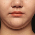 double chin liposuction