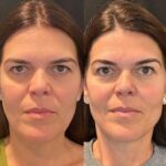 Best Plastic Surgeons in Dubai Offering Superior Safe PDO Thread Lift Technology