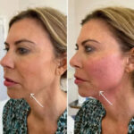 How Endolift Treatment in Dubai Enhances Overall Facial Harmony