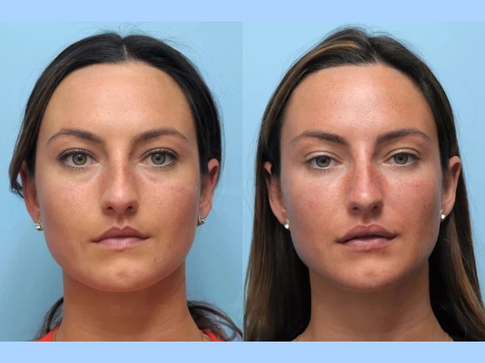 Natural Thread lift treatment in Dubai Improving Jawline and Cheek Contours