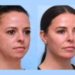 Best Aesthetic Clinics in Dubai Perform Thread Lift for Tighter Skin