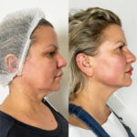Best Doctors in Dubai for Natural Facial Contouring with Endolift
