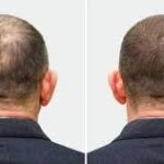 زراعة الشعر في الرياض