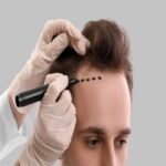 زراعة الشعر في الرياض