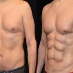 Sixpack Liposuction in Dubai