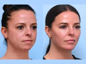 Best Aesthetic Clinics in Dubai Perfect Facial Contours Using Thread Lift
