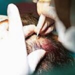 تكلفة زراعة الشعر في الرياض