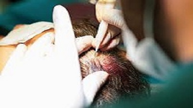 تكلفة زراعة الشعر في الرياض