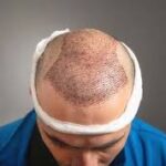  تكلفة زراعة الشعر في الرياض