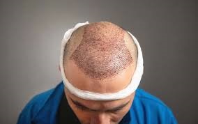  تكلفة زراعة الشعر في الرياض