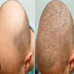تكلفة زراعة الشعر في الرياض