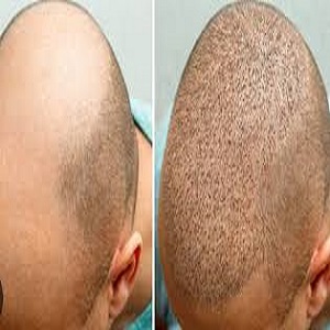 تكلفة زراعة الشعر في الرياض