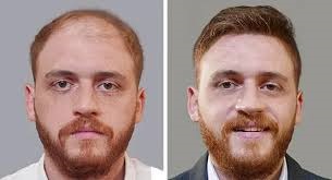 تكلفة زراعة الشعر في الرياض