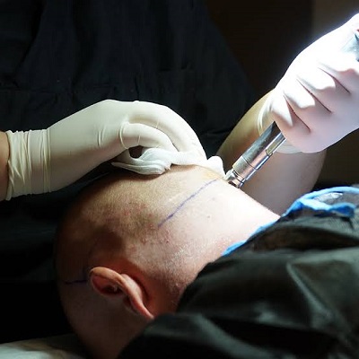زراعة الشعر في دبي