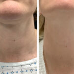 Best Doctors in dubai for Radiofrequency Microneedling to Minimize Pores