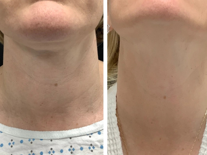 Best Doctors in dubai for Radiofrequency Microneedling to Minimize Pores