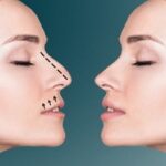 تجميل الأنف في الرياض