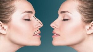 تجميل الأنف في الرياض