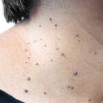 Skin-Tag-Removal-