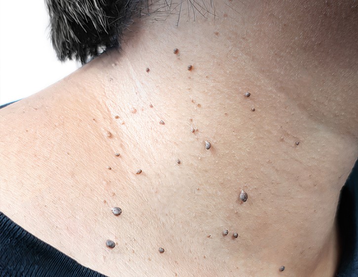 Skin-Tag-Removal-