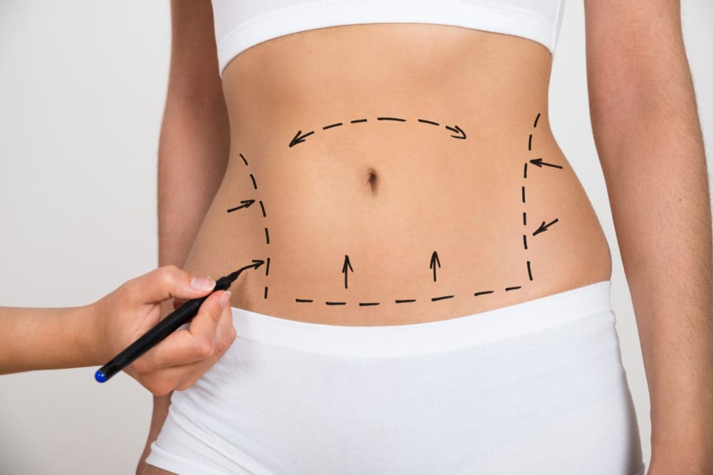 Abdominoplasty in Dubai: Choosing the Right Tummy Tuck Approach