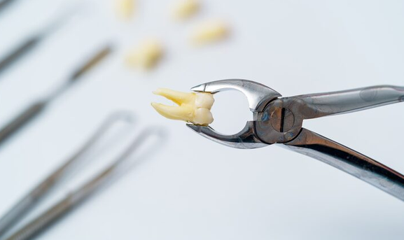 dental extraction athens al