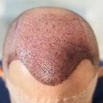 تكلفة زراعة الشعر في الرياض