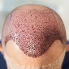 تكلفة زراعة الشعر في الرياض