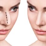 تجميل الأنف في الرياض