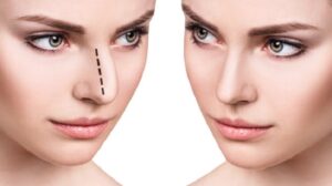 تجميل الأنف في الرياض