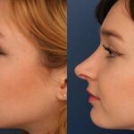 تجميل الأنف في الرياض