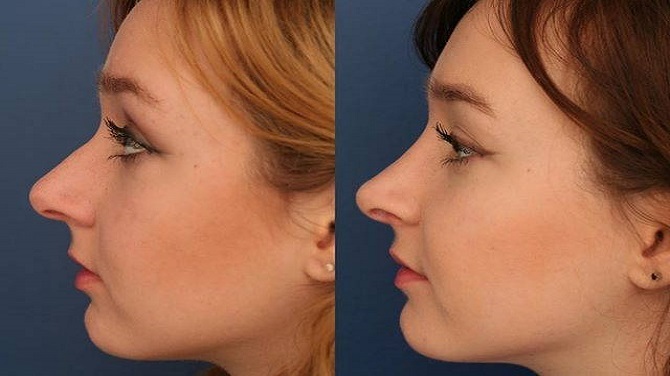 تجميل الأنف في الرياض