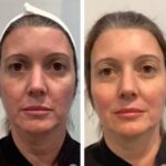 Best Plastic Surgeons in Dubai: Advanced Skin Tightening Thread Lift Procedures