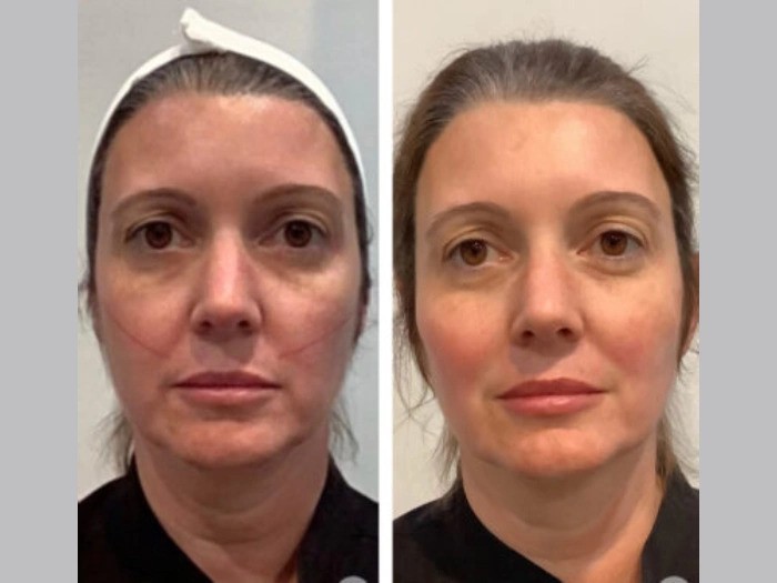 Best Plastic Surgeons in Dubai: Advanced Skin Tightening Thread Lift Procedures