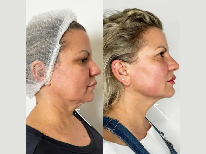 Best Aesthetic Clinics in dubai offering luxury Endolift treatment experience