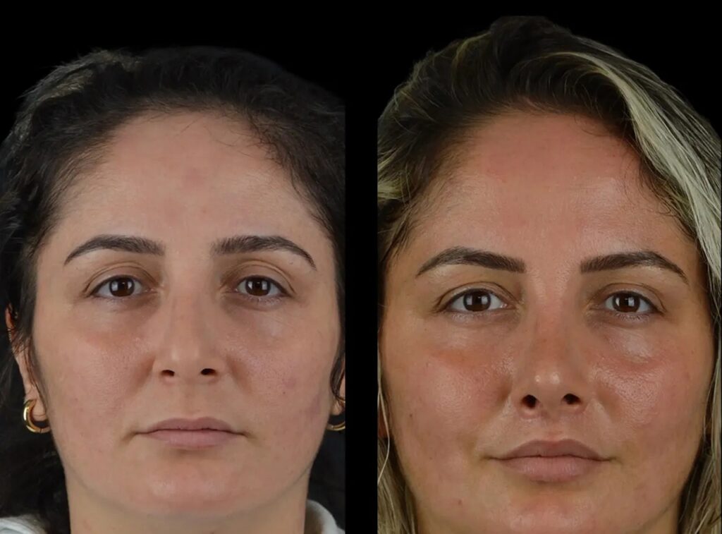 cheek fillers in dubai