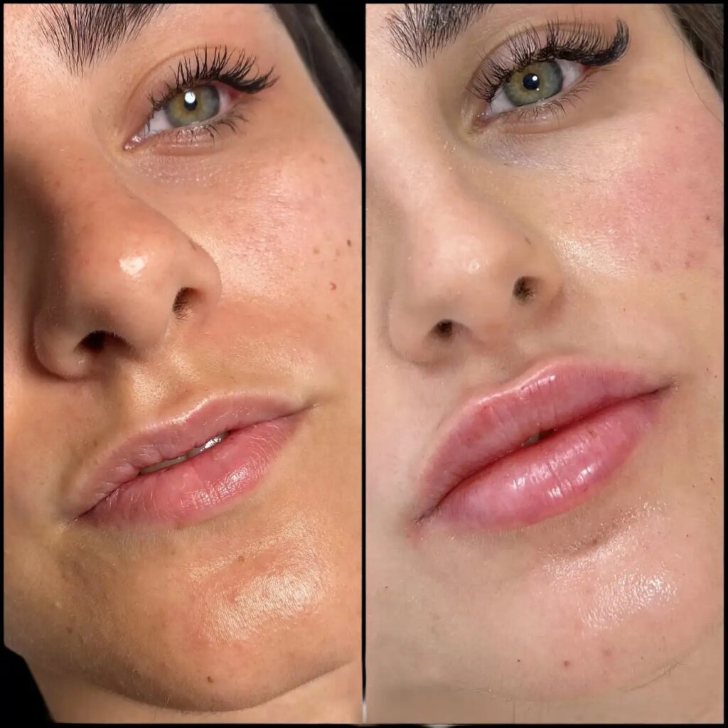 dermal fillers in dubai