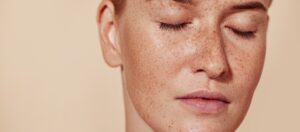Understanding Recovery After Pigmentation Treatment in Dubai