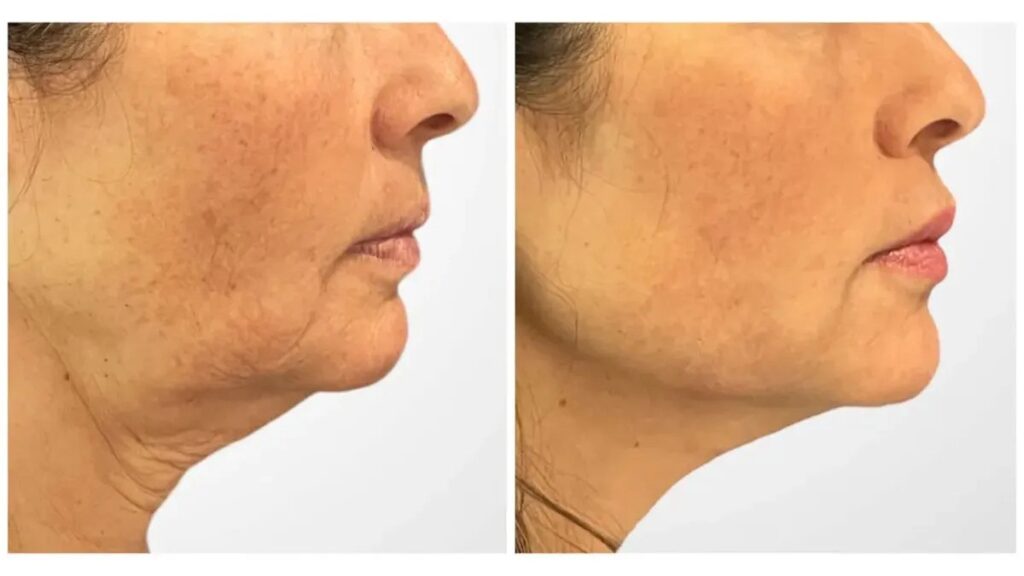 Thread lift treatments in Dubai Personalized Cosmetic Care for Youthful Skin Appearance