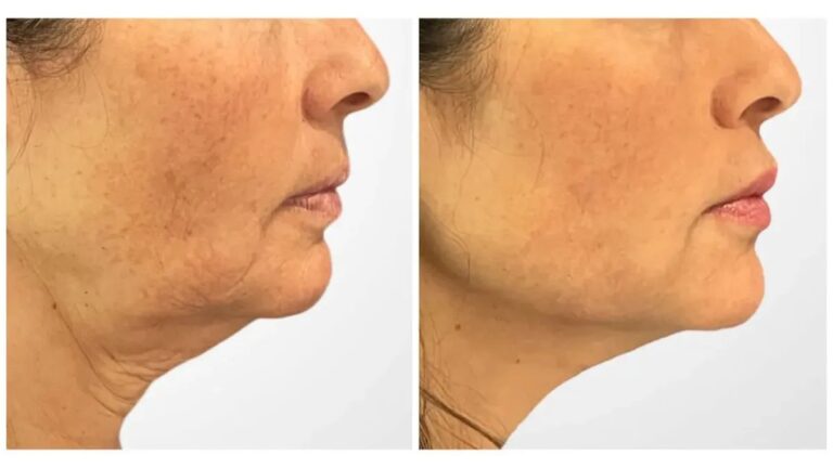 Thread lift treatments in Dubai Personalized Cosmetic Care for Youthful Skin Appearance
