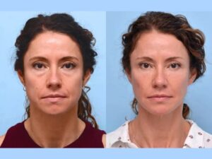 Best Doctors in Dubai Providing Advanced PDO Thread Lift Treatments